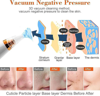Blackhead Remover Vacuum – Deep Pore Cleaner with 3 Suction Levels & 7 Heads