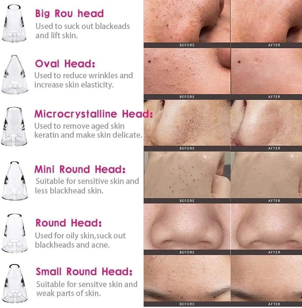 Blackhead Remover Vacuum – Deep Pore Cleaner with 3 Suction Levels & 7 Heads