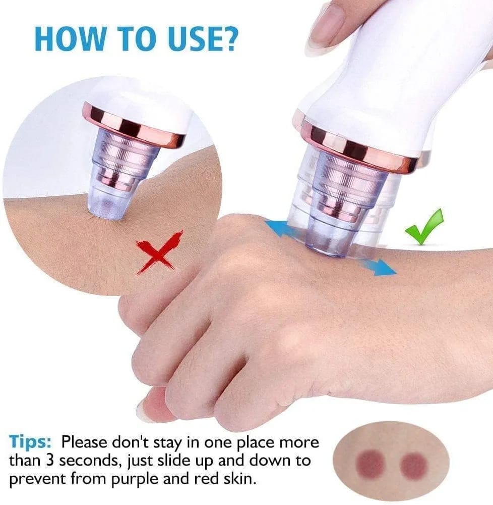 Blackhead Remover Vacuum – Deep Pore Cleaner with 3 Suction Levels & 7 Heads